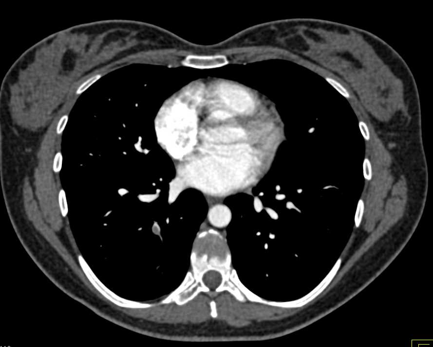 Pulmonary Embolism - CTisus CT Scan