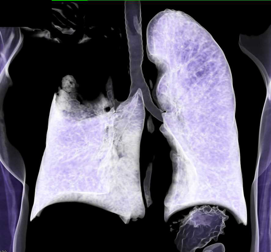 Neurogenic Sarcoma Right Chest and Chest Wall - CTisus CT Scan