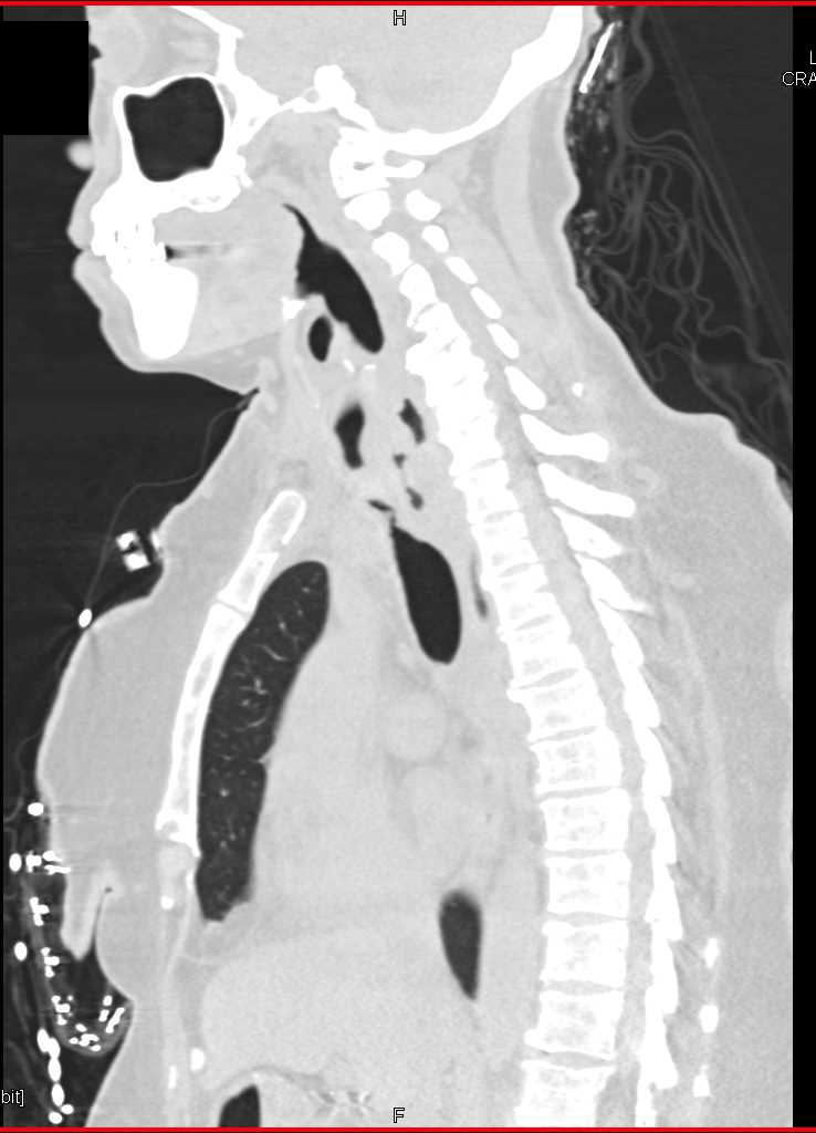 Virtual Bronchoscopy with Tracheal Stenosis - CTisus CT Scan