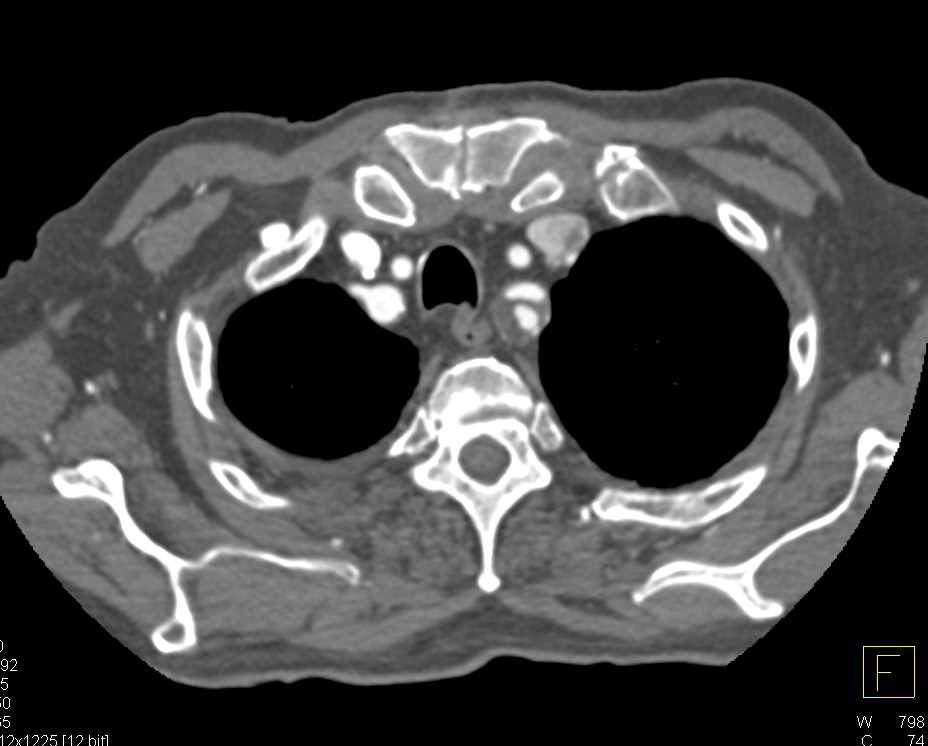Aneurysm Arch with Aneurysm Left Subclavian Artery - CTisus CT Scan