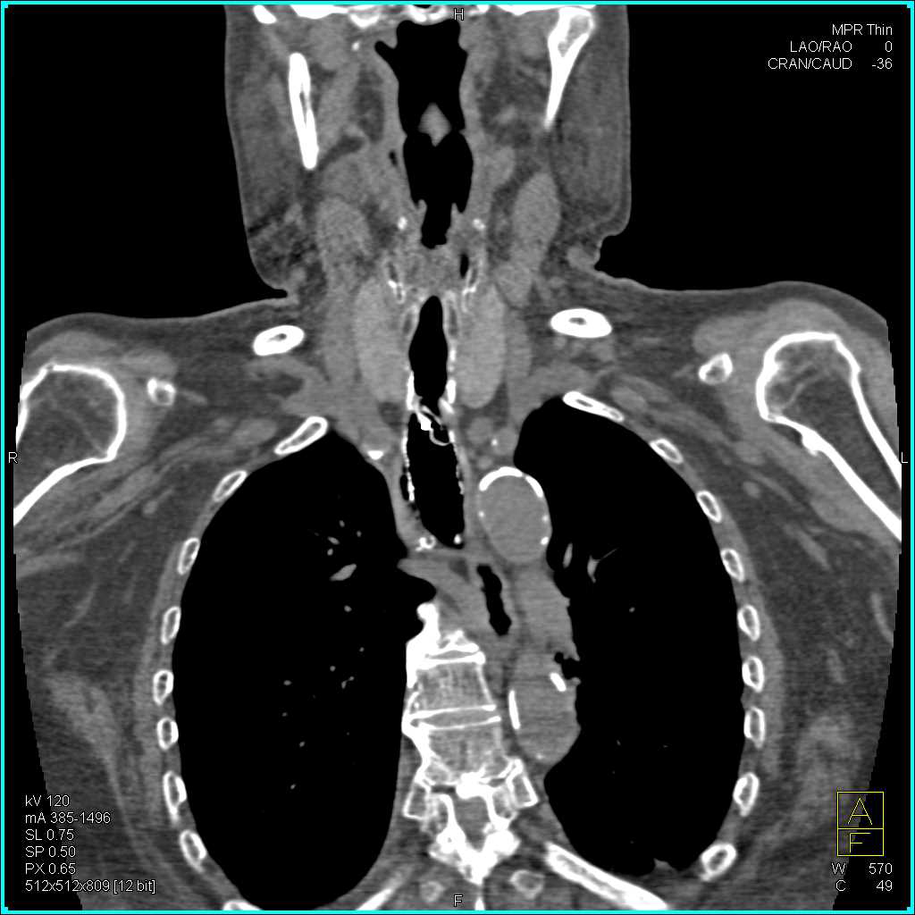 Stent in Trachea in 3D - CTisus CT Scan