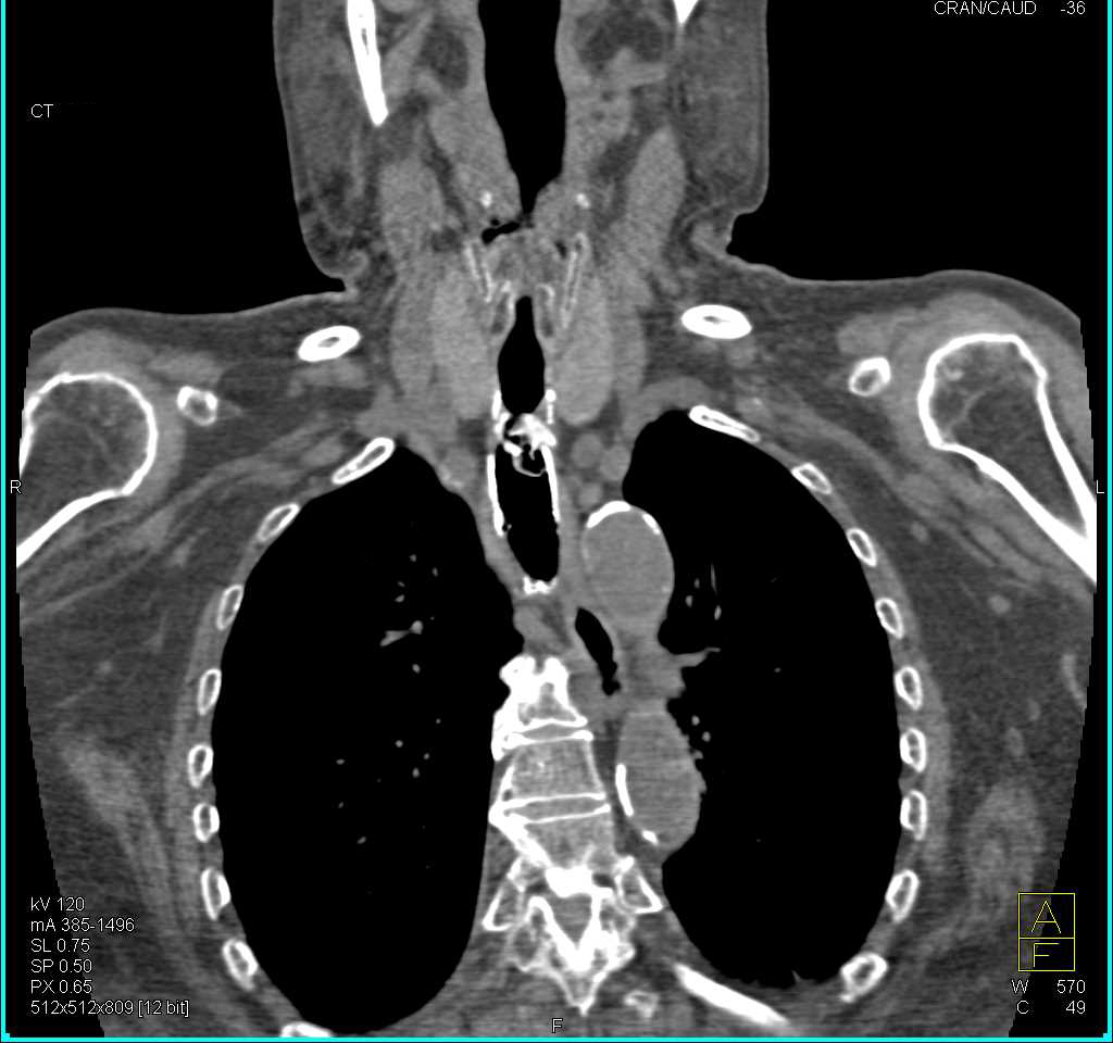 Stent in Trachea in 3D with Tracheal Stenosis - CTisus CT Scan