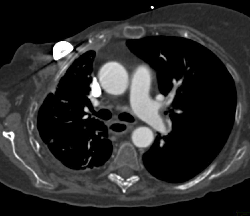 Pulmonary Embolism - CTisus CT Scan