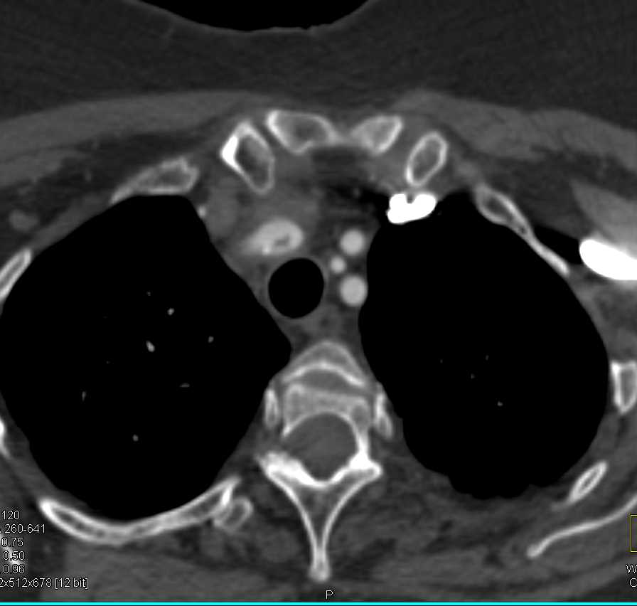 Stent in Right Innominate Artery - CTisus CT Scan