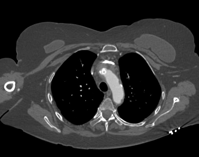 Stent in Right Innominate Artery - CTisus CT Scan