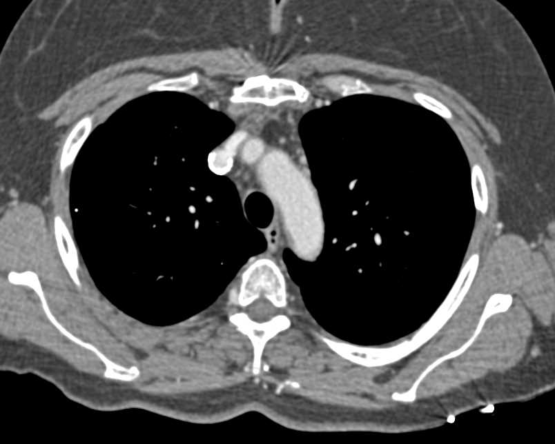 Patent Stent in the Superior Vena Cava (SVC) - CTisus CT Scan