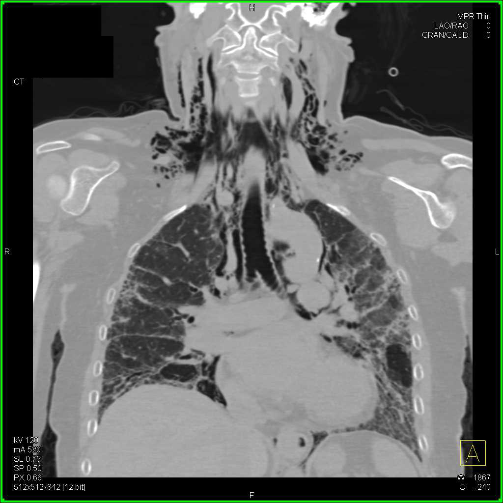 Interstitial Lung Disease with Spontaneous Pneumomediastinum and Superimposed Infiltrates vs Hemorrhage - CTisus CT Scan