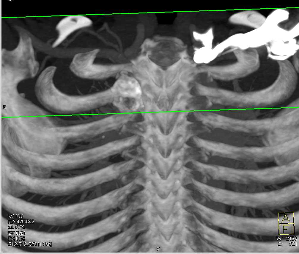 Pancoast Tumor in Right Apex - CTisus CT Scan