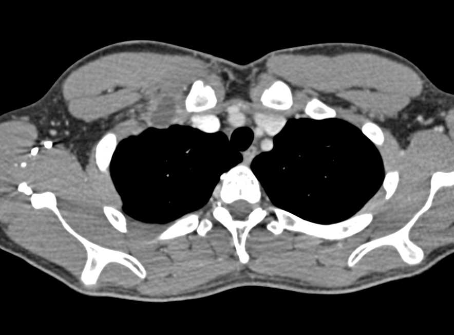 Abscess Right Chest Wall Extends into Muscle and Vascularity - CTisus CT Scan