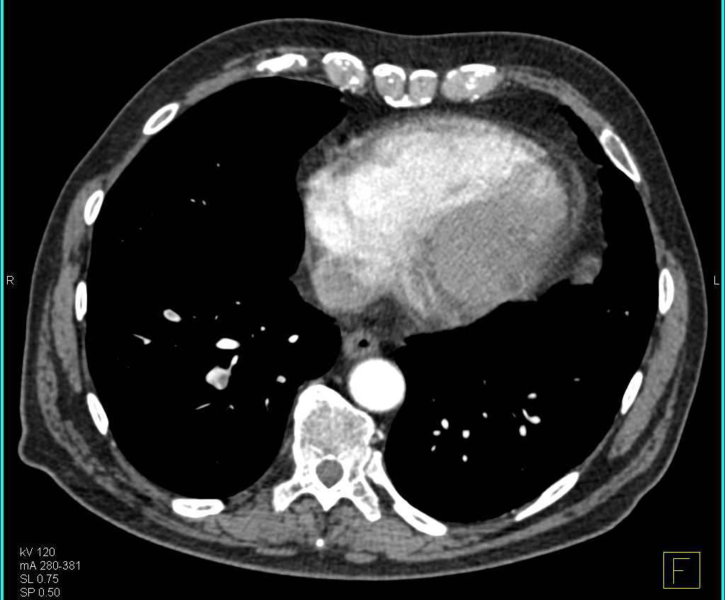 Multiple Pulmonary Emboli (PEs) in a Patient With Pancreatic Cancer - CTisus CT Scan