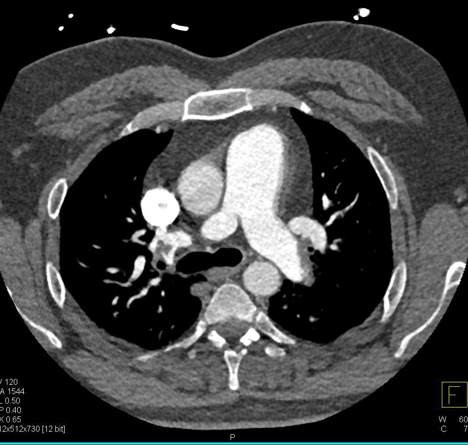 Multiple Pulmonary Emboli (PEs) in a Patient Who Presented With Syncope - CTisus CT Scan