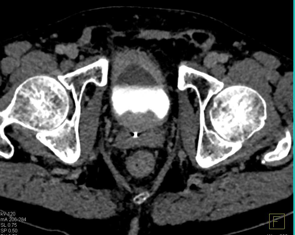 Multiple Pulmonary Emboli in Patient with Bladder Cancer - CTisus CT Scan