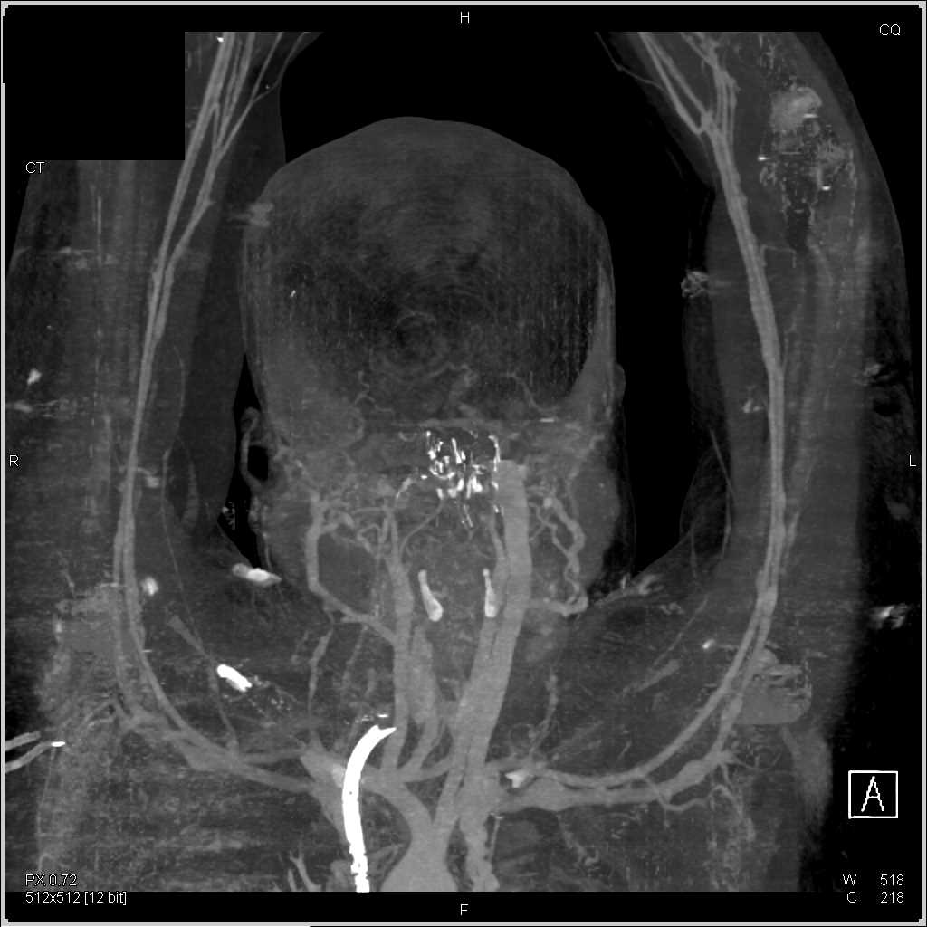 Lymphoma Infiltrates the Vessels in the Right Neck - CTisus CT Scan