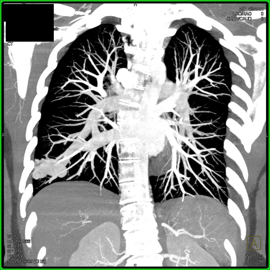 Pulmonary Arterial Vascular Malformation (PAVM) - CTisus CT Scan