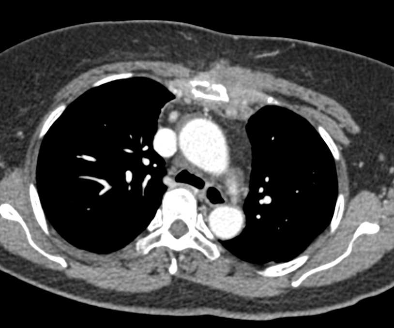 Lymphoma with Supraclavicular Nodes and Sternal Tumor - CTisus CT Scan