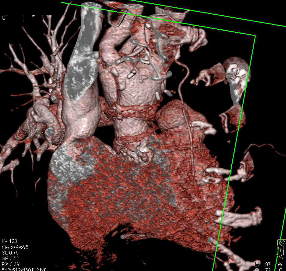 Type A Dissection with Repair - CTisus CT Scan