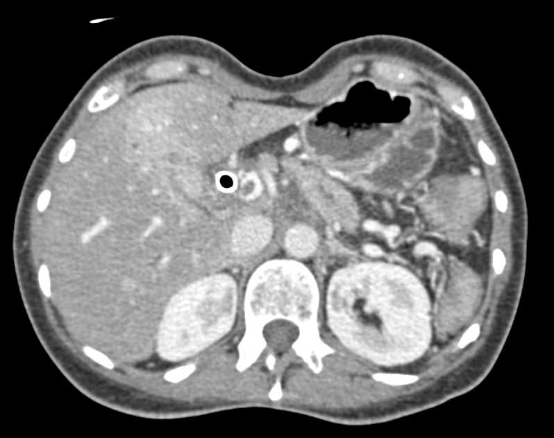Incidental Pulmonary Embolism in Pancreatic Cancer Patient - CTisus CT Scan