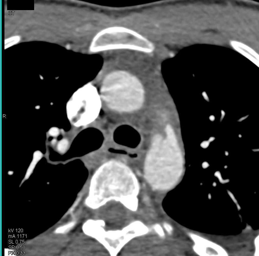 Patent Ductus Arteriosus (PDA) - CTisus CT Scan