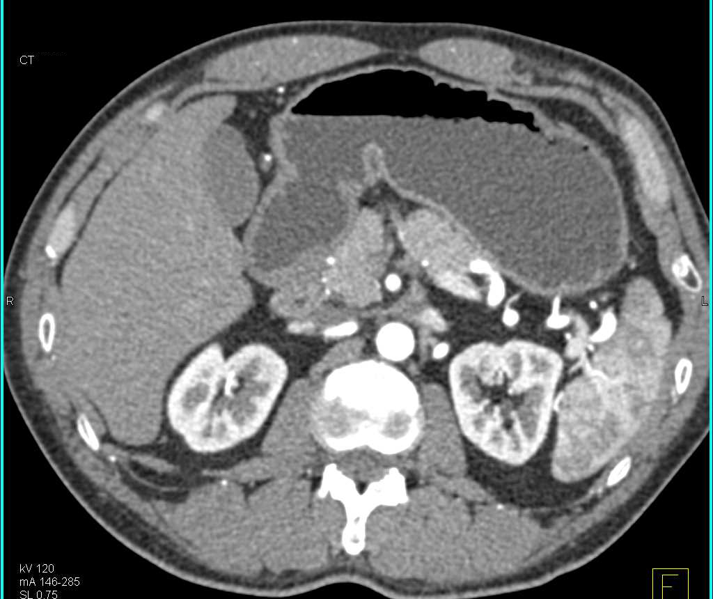 Stent Repair of Coarctation of the Aorta - CTisus CT Scan
