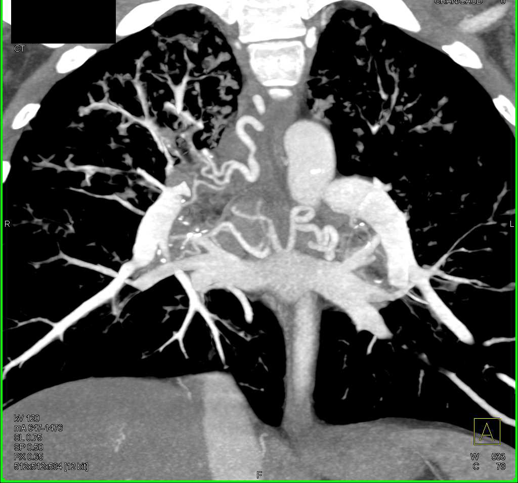 Cystic Fibrosis with Dilated Bronchial Arteries - CTisus CT Scan