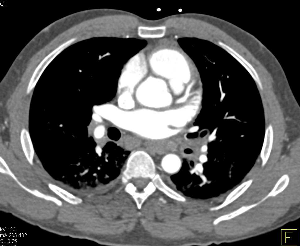 Pulmonary Hypertension and Pulmonary Hemorrhage - CTisus CT Scan