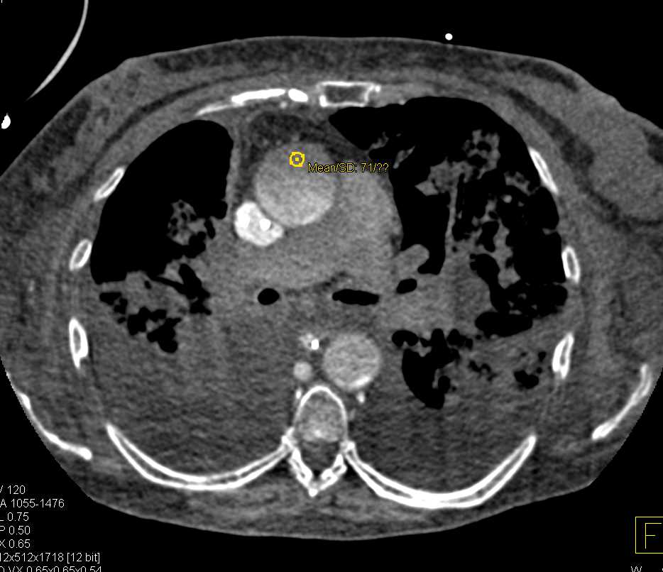 Acute Respiratory Distress Syndrome (ARDS) with Poor Cardiac Output - CTisus CT Scan