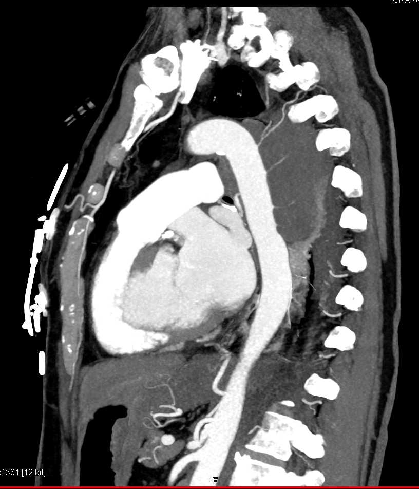 Tumor Infiltrates the Posterior Mediastinum and Encases the Aorta - CTisus CT Scan
