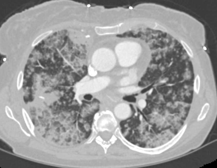 Diffuse Alveolar Infiltrates due to Hemorrhage - CTisus CT Scan