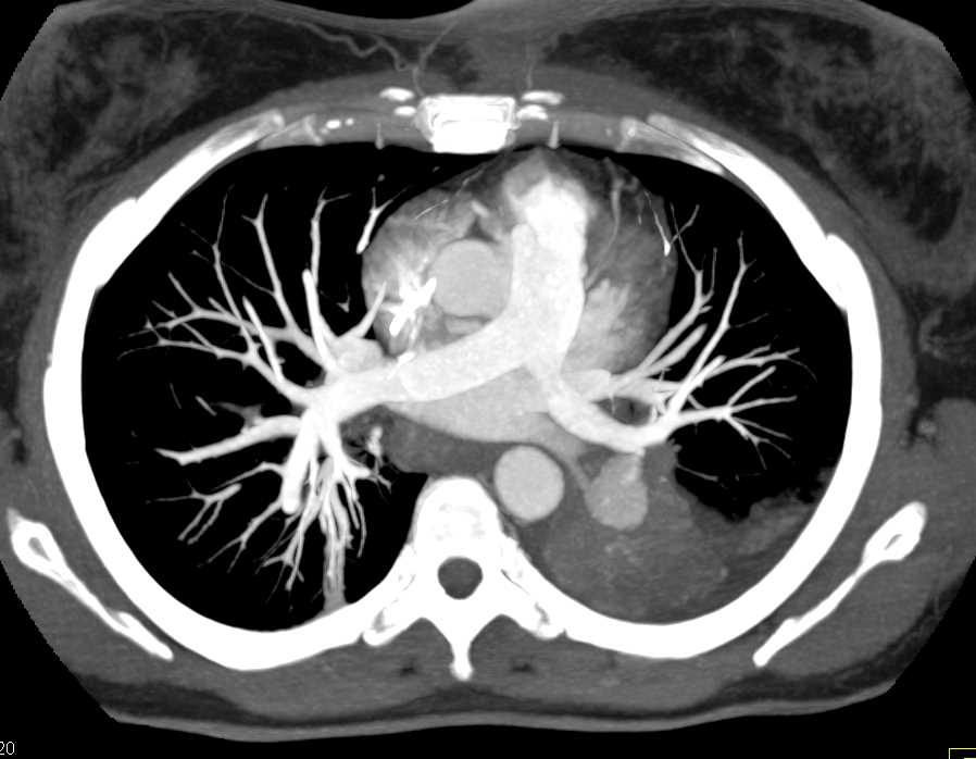 Pulmonary Artery Pseudoaneurysm - CTisus CT Scan