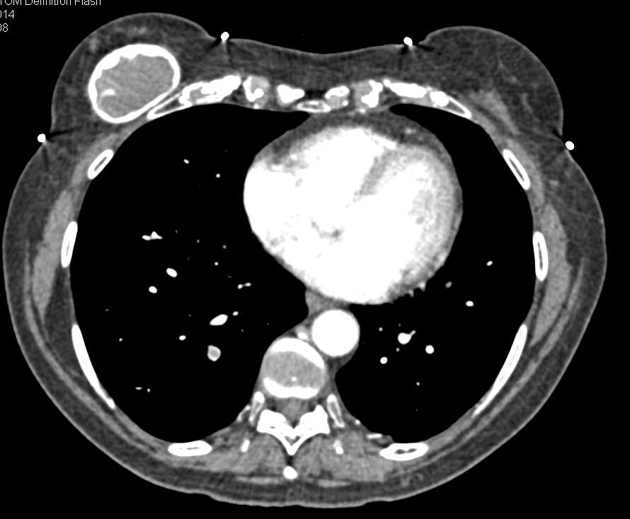 Incidental Pulmonary Embolism in a Patient with Pancreatic Cancer - CTisus CT Scan