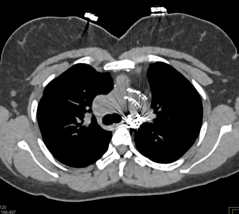 Stent Placed for Repair of a Coarctation of the Aorta - CTisus CT Scan