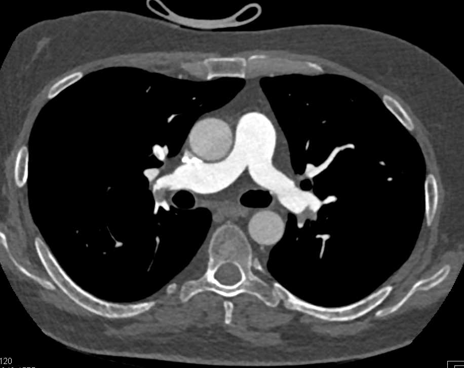Extensive Pulmonary Embolism - CTisus CT Scan