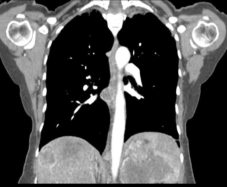 Metastatic Melanoma - CTisus CT Scan