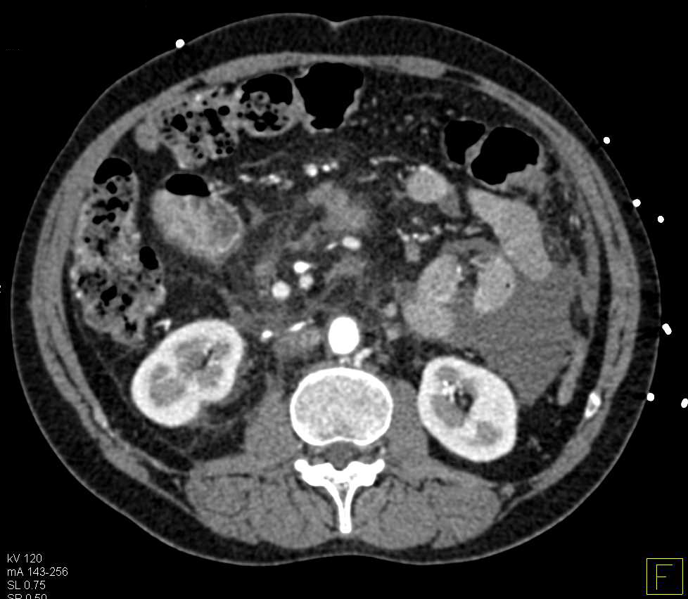 Carcinomatosis with Cavitary Lung Lesions - CTisus CT Scan