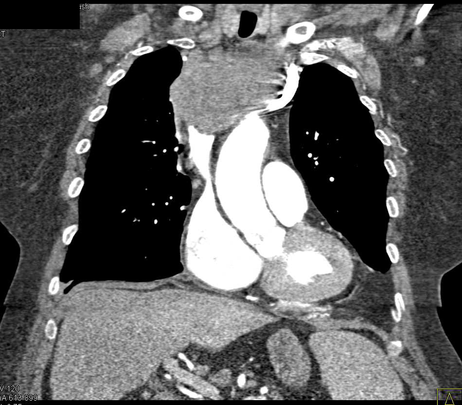 Lymphoma Involves the Mediastinum - CTisus CT Scan