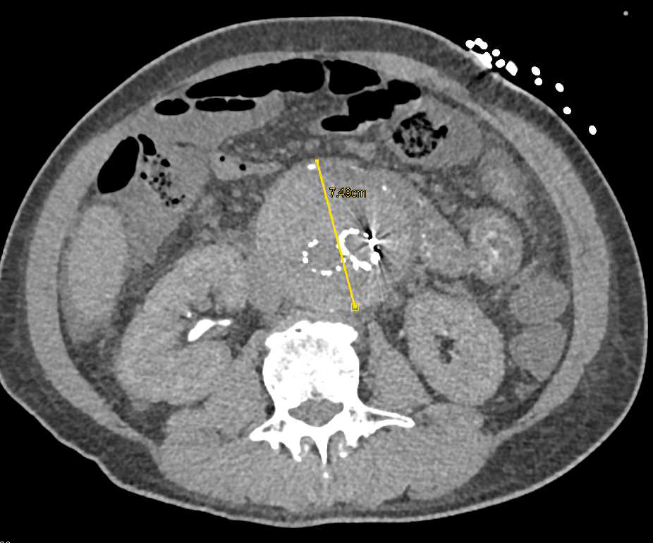 Ruptured Right Hemidiaphragm with Small Bowel in Chest - CTisus CT Scan