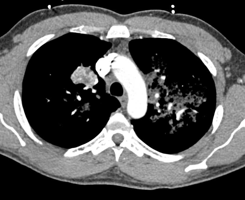 Pulmonary Hemorrhage Best Seen in the Left Lung - CTisus CT Scan