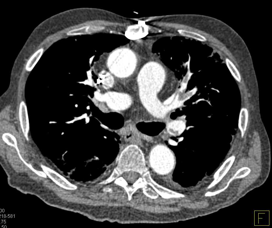 Multiple Bilateral Pulmonary Emboli - CTisus CT Scan