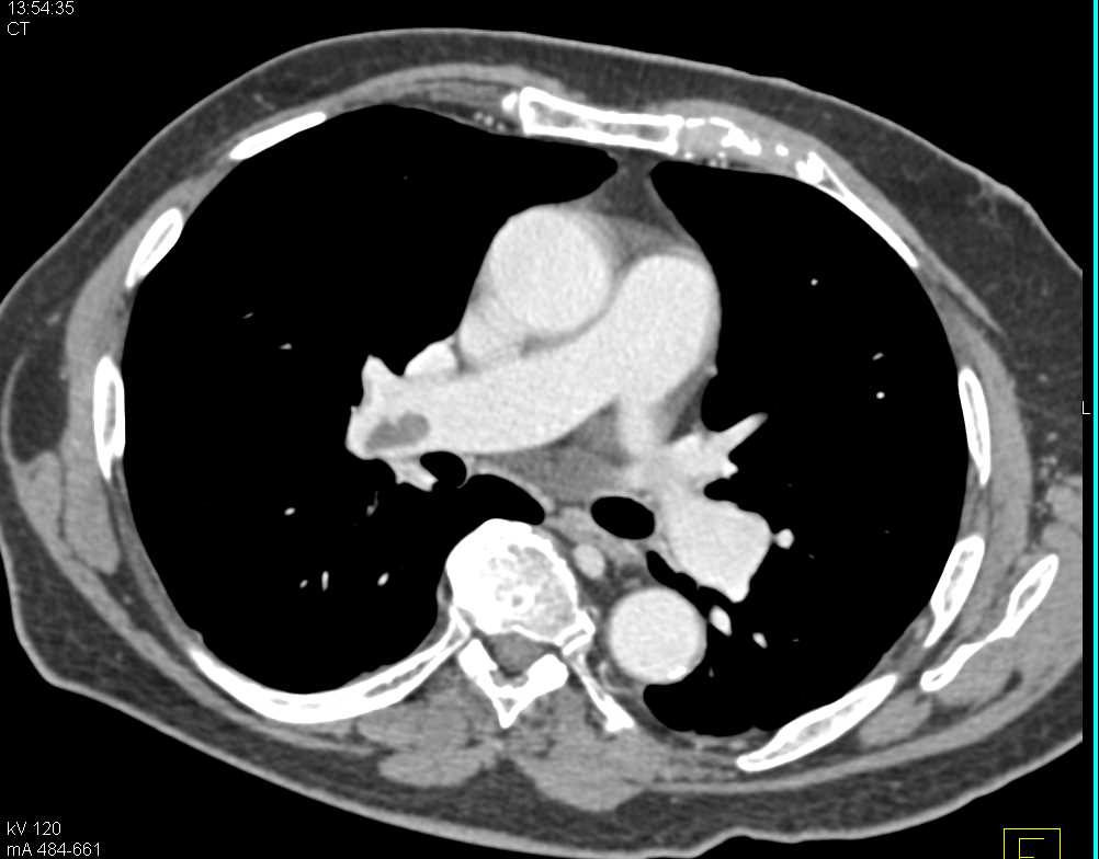 Arteriovenous (AV) Fistulae for Dialysis in Left Arm and Pulmonary Embolism - CTisus CT Scan