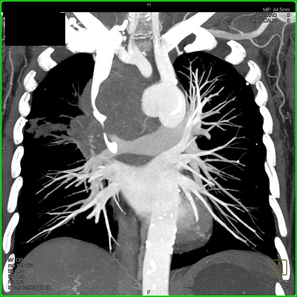 Superior Vena Cava (SVC) Syndrome due to Small Cell Lung Cancer - CTisus CT Scan