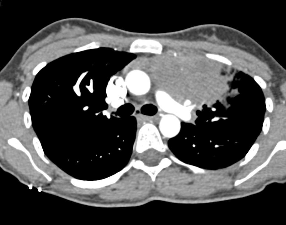 Lymphoma Involves the Chest Wall - CTisus CT Scan