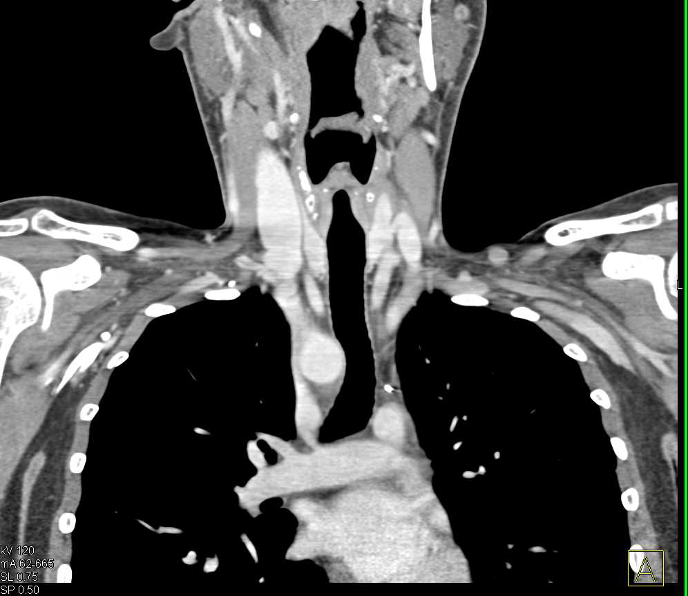Vascular Mapping of the Neck and Supra-clavicular Zone - CTisus CT Scan