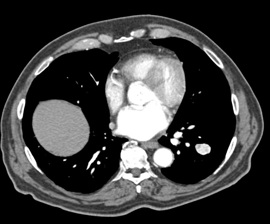 Metastatic Renal Cell Carcinoma to the Pancreas and Lung - CTisus CT Scan