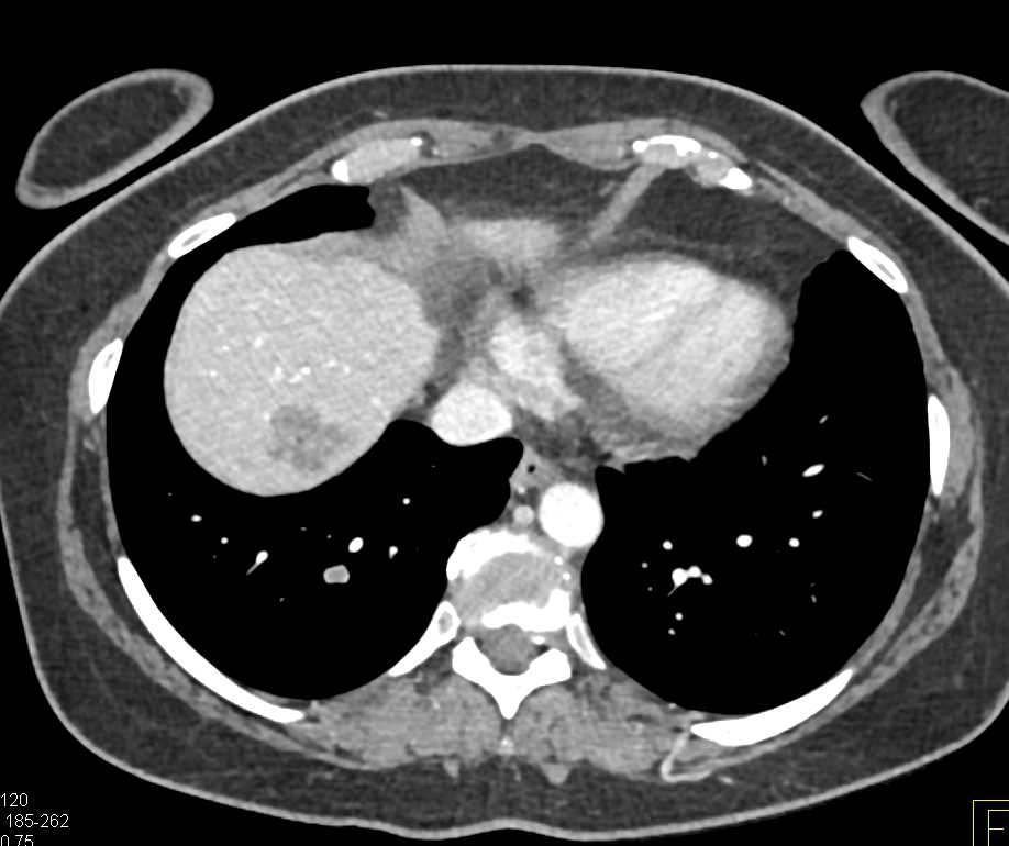 Pulmonary Embolism in Right Lower Lobe - CTisus CT Scan