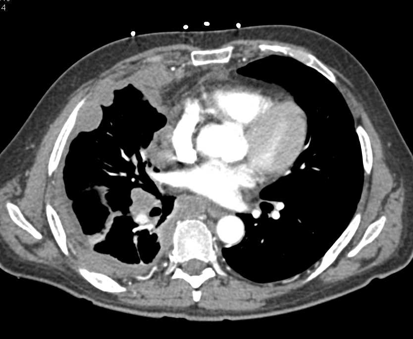 Mesothelioma with Radiation Hepatitis Changes in the Liver - CTisus CT Scan