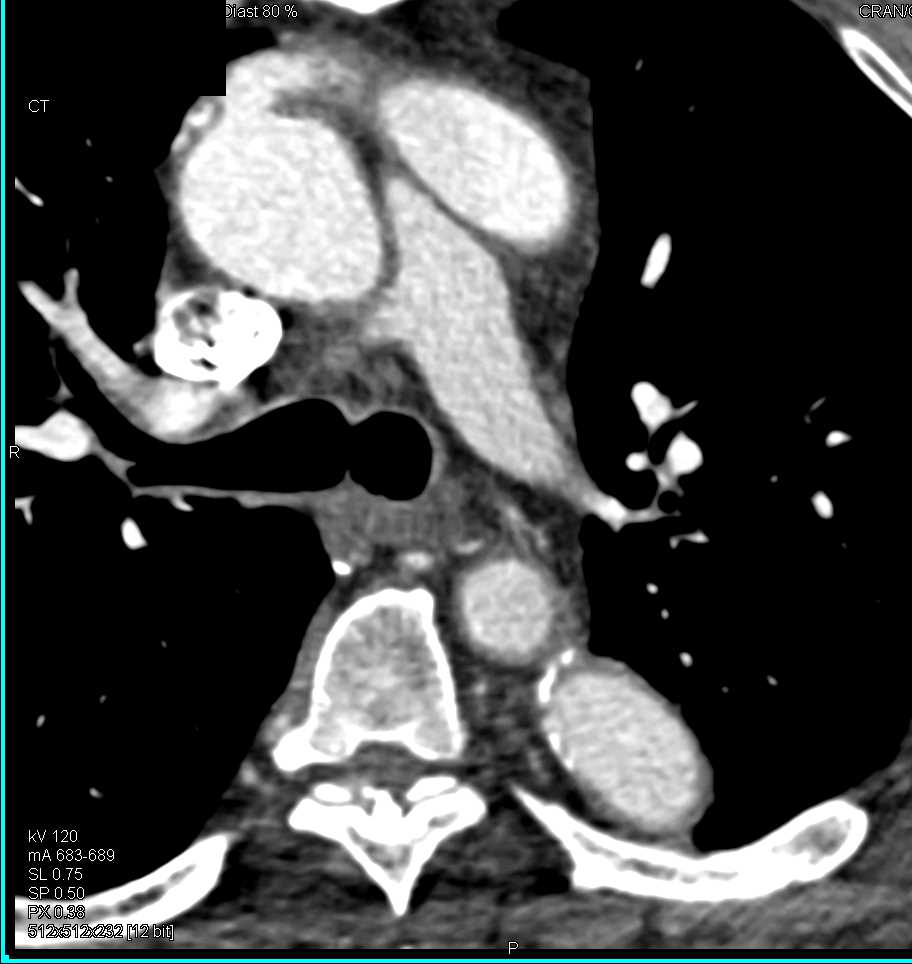 Coarctation of the Aorta Treated with a Vascular Bypass Graft - CTisus CT Scan