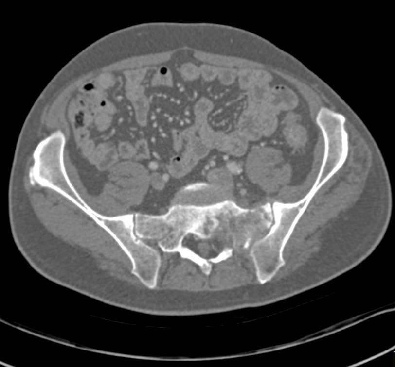 Multiple Incidental Pulmonary Emboli (PEs) in an Oncology Patient - CTisus CT Scan