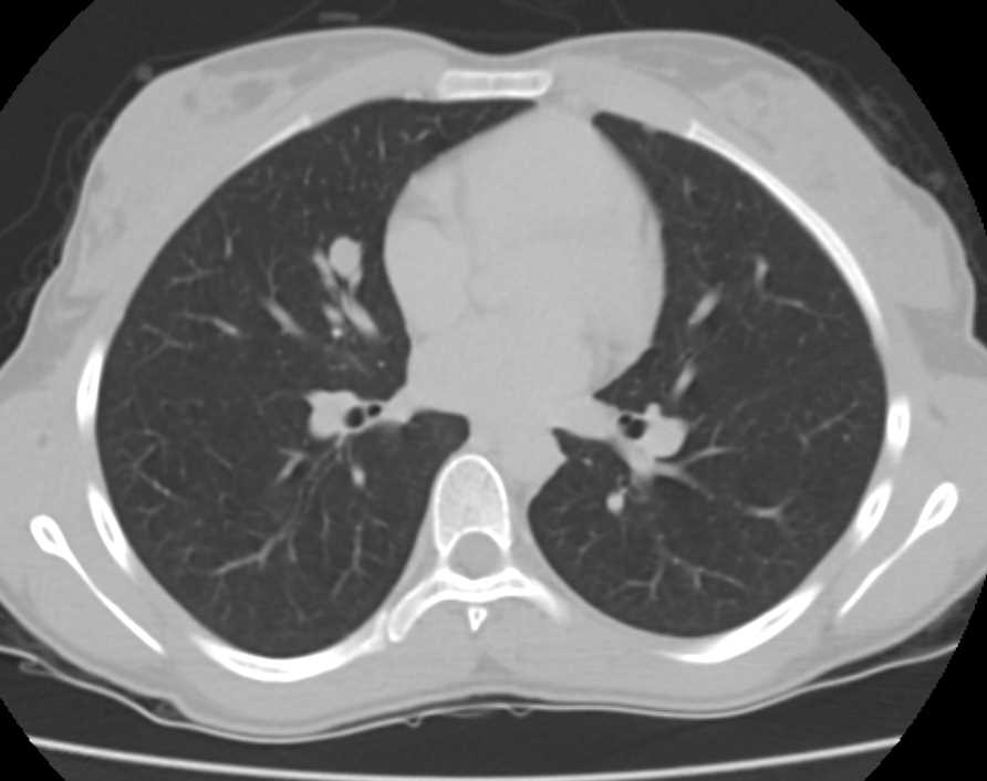 Metastatic Breast Cancer to Lung and Pleura - CTisus CT Scan