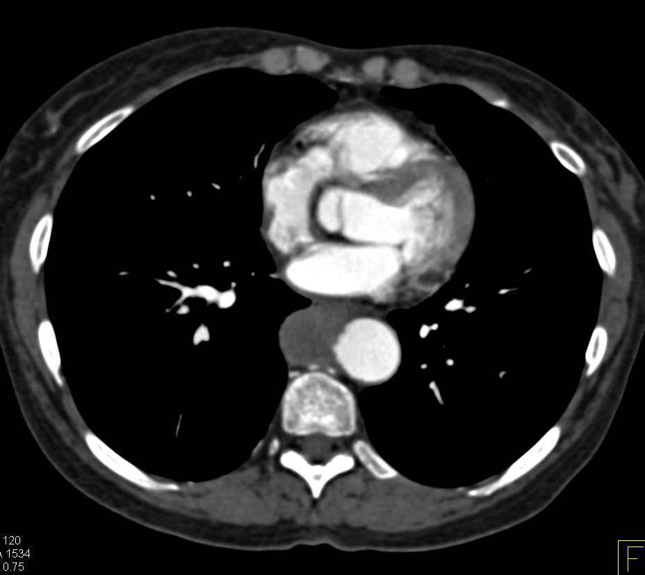 Mediastinal Mass Erodes the Aorta - CTisus CT Scan