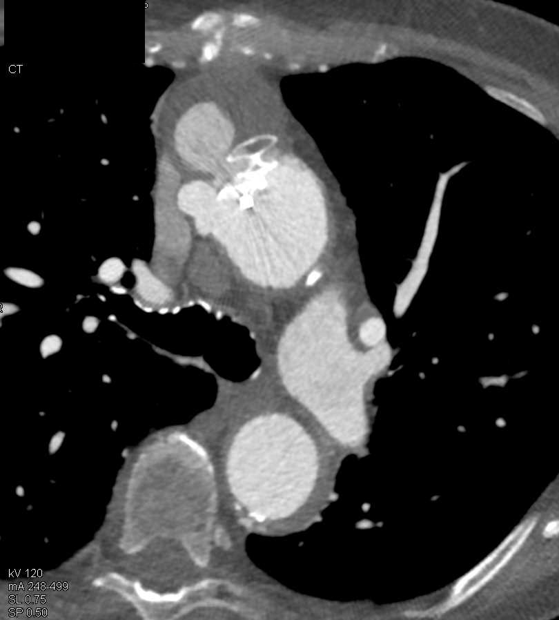 Pseudoaneurysm Ascending Aorta with Amplatzer Occluder Device - CTisus CT Scan